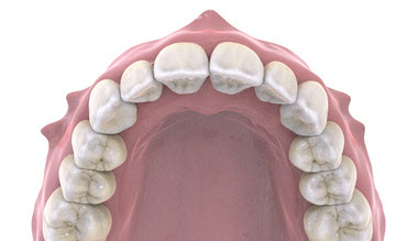 Небольшие множественные нарушения положения зубов