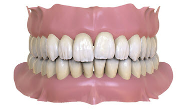 Интрузированный зуб