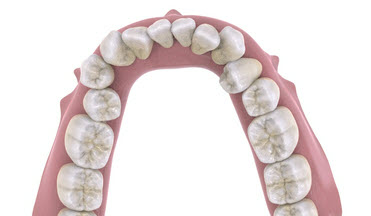 Скученность зубов на одной челюсти